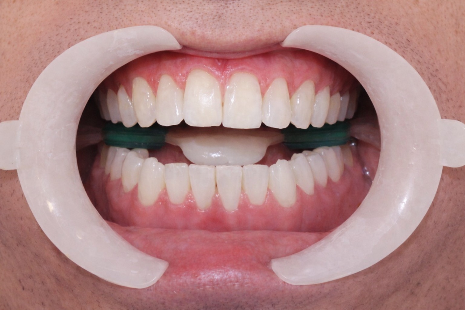Clareamento dental — depois