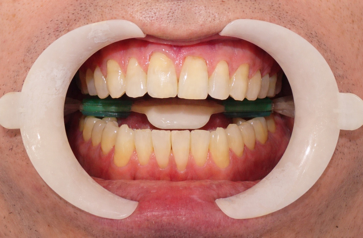 Clareamento dental — antes