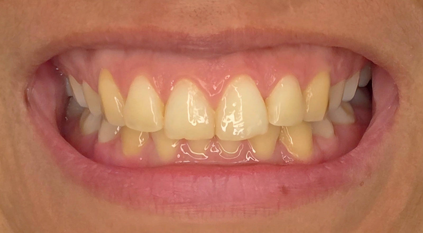 Clareamento dental — antes